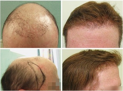 Hair Transplant in Dubai